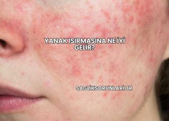 Yanak Isırmasına Ne İyi Gelir?