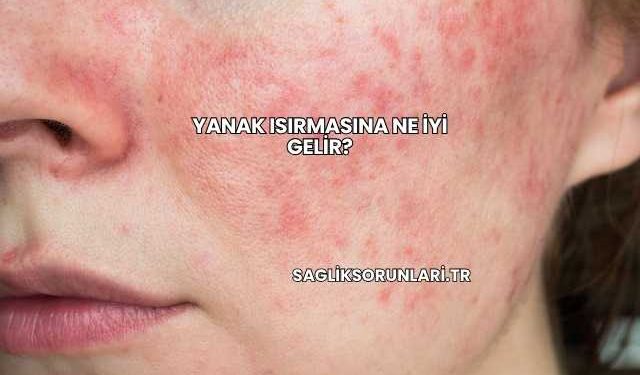 Yanak Isırmasına Ne İyi Gelir?