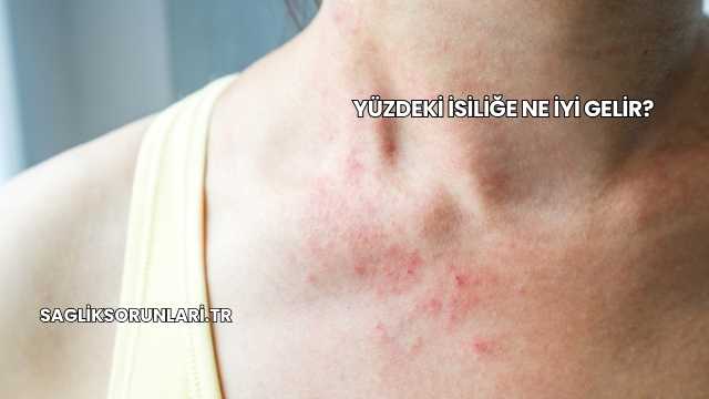 Yüzdeki İsiliğe Ne İyi Gelir?