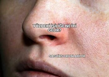 Yüzdeki İsiliğe Ne İyi Gelir?