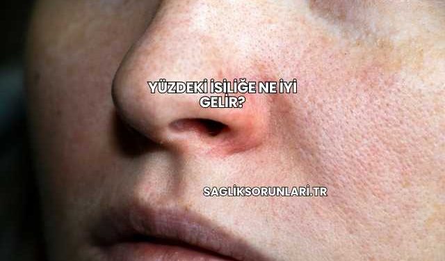 Yüzdeki İsiliğe Ne İyi Gelir?
