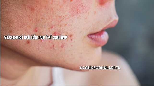Yüzdeki İsiliğe Ne İyi Gelir?