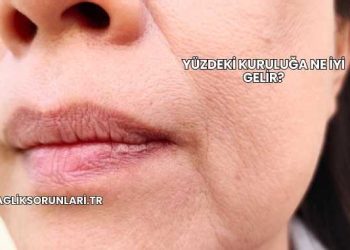 Yüzdeki Kuruluğa Ne İyi Gelir?