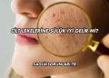 Cilt Lekelerine Sülük İyi Gelir mi?