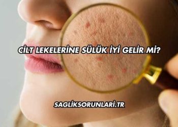 Cilt Lekelerine Sülük İyi Gelir mi?