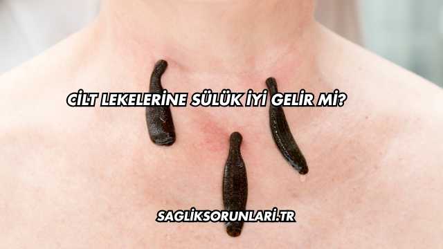 Cilt Lekelerine Sülük İyi Gelir mi?