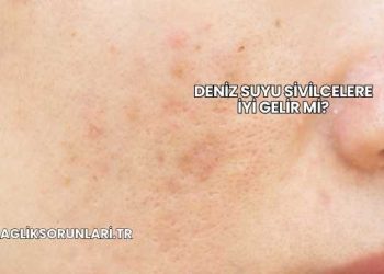 Deniz Suyu Sivilcelere İyi Gelir mi?