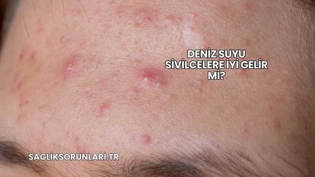Deniz Suyu Sivilcelere İyi Gelir mi?