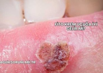 Fito Krem Uçuğa İyi Gelir mi?
