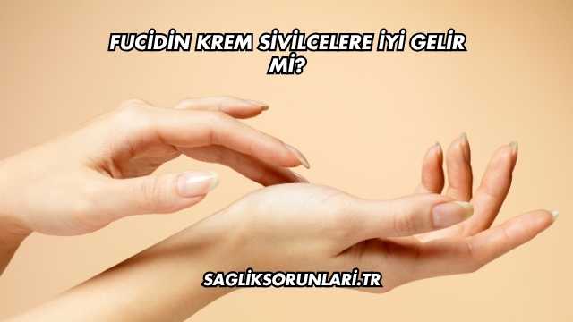 Fucidin Krem Sivilcelere İyi Gelir mi?