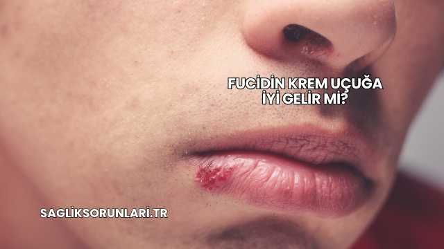 Fucidin Krem Uçuğa İyi Gelir mi?