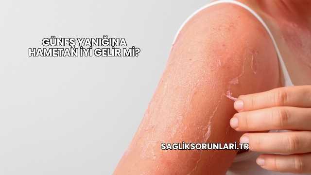 Güneş Yanığına Hametan İyi Gelir mi?