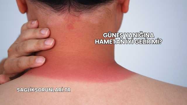 Güneş Yanığına Hametan İyi Gelir mi?