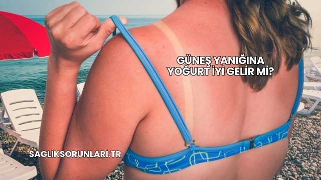 Güneş Yanığına Yoğurt İyi Gelir mi?