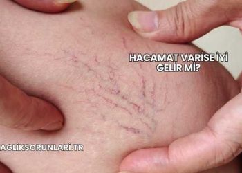 Hacamat Varise İyi Gelir mi?
