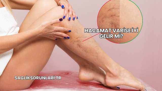 Hacamat Varise İyi Gelir mi?