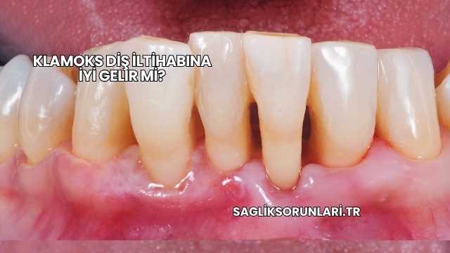 Klamoks Diş İltihabına İyi Gelir mi?