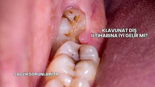 Klavunat Diş İltihabına İyi Gelir mi?