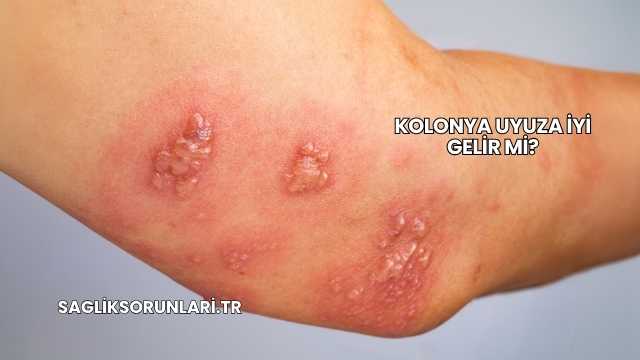 Kolonya Uyuza İyi Gelir mi?