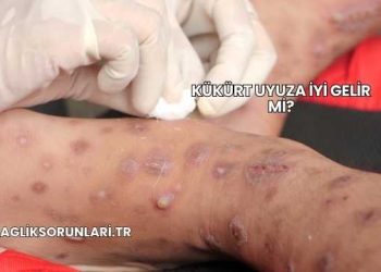 Kükürt Uyuza İyi Gelir mi?