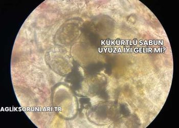 Kükürtlü Sabun Uyuza İyi Gelir mi?