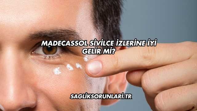 Madecassol Sivilce İzlerine İyi Gelir mi?