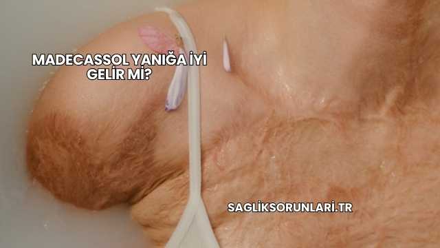 Madecassol Yanığa İyi Gelir mi?
