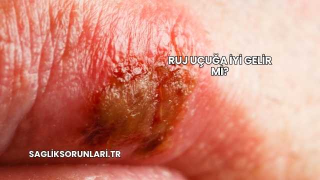 Ruj Uçuğa İyi Gelir mi?