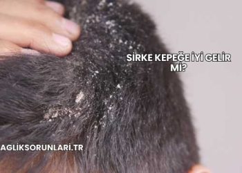 Sirke Kepeğe İyi Gelir mi?