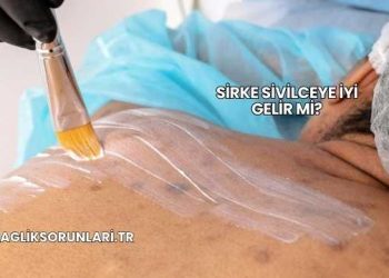 Sirke Sivilceye İyi Gelir mi?