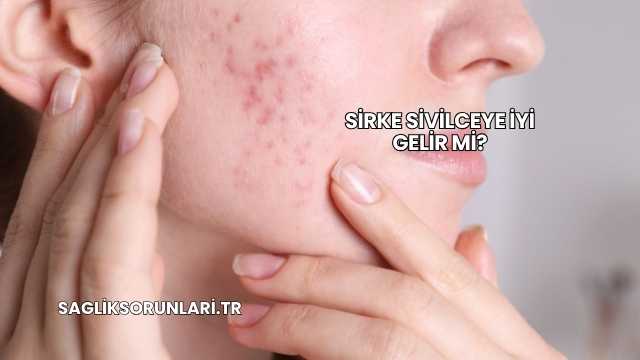 Sirke Sivilceye İyi Gelir mi?