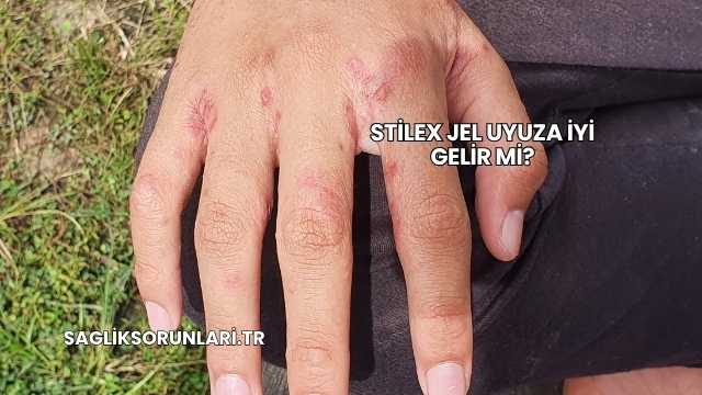 Stilex Jel Uyuza İyi Gelir mi?