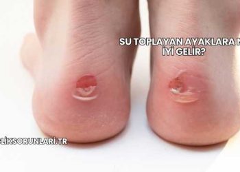 Su Toplayan Ayaklara Ne İyi Gelir?