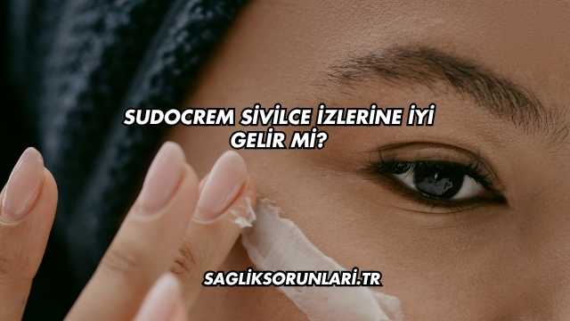 Sudocrem Sivilce İzlerine İyi Gelir mi?