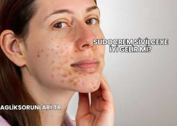 Sudocrem Sivilceye İyi Gelir mi?