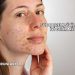 Sudocrem Sivilceye İyi Gelir mi?