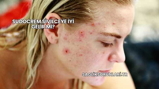 Sudocrem Sivilceye İyi Gelir mi?