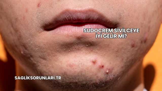 Sudocrem Sivilceye İyi Gelir mi?