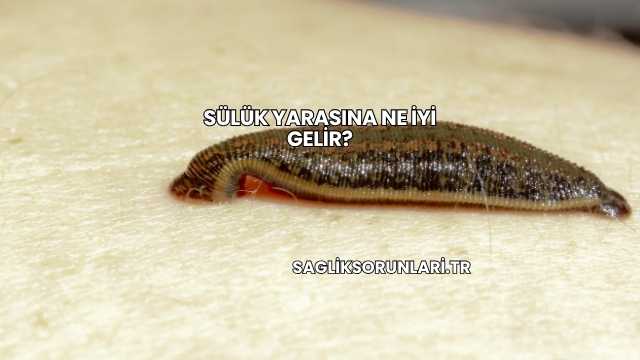 Sülük Yarasına Ne İyi Gelir?