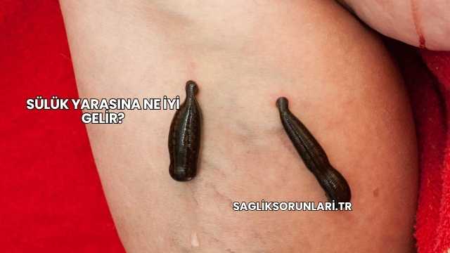 Sülük Yarasına Ne İyi Gelir?