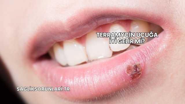Terramycin Uçuğa İyi Gelir mi?