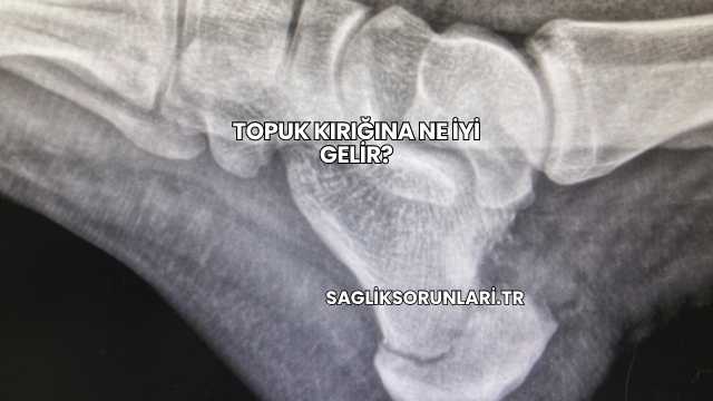 Topuk Kırığına Ne İyi Gelir?