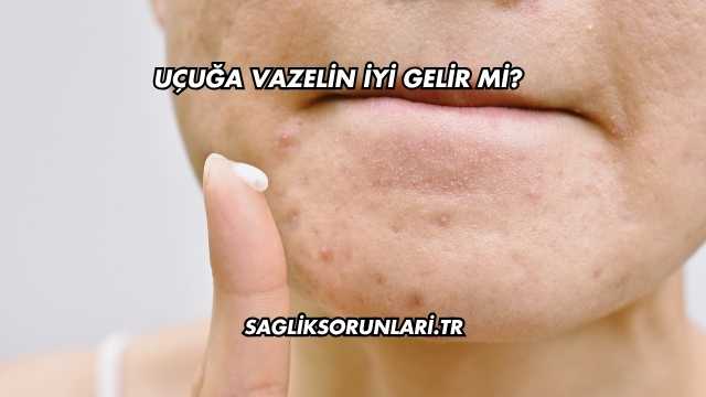 Uçuğa Vazelin İyi Gelir mi?