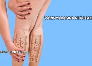 Varis Yarasına Ne İyi Gelir?