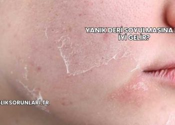 Yanık Deri Soyulmasına Ne İyi Gelir?