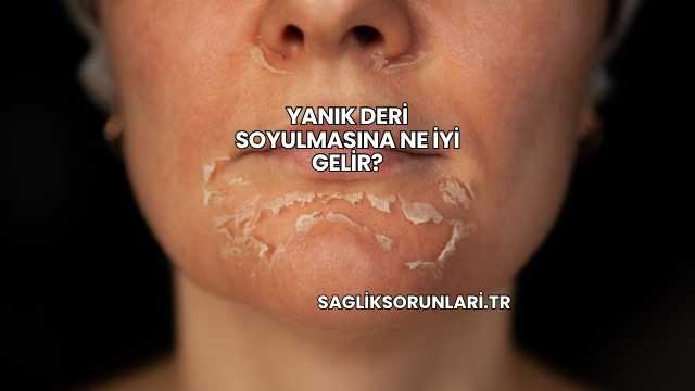 Yanık Deri Soyulmasına Ne İyi Gelir?