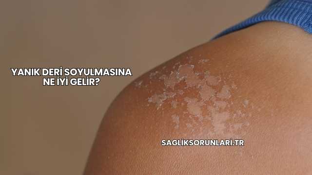 Yanık Deri Soyulmasına Ne İyi Gelir?