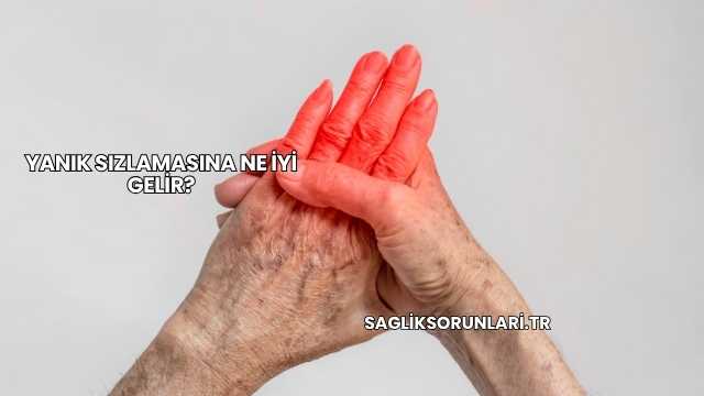 Yanık Sızlamasına Ne İyi Gelir?