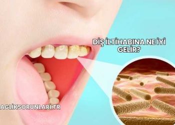 Diş İltihabına Ne İyi Gelir?