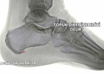 Topuk Dikenine Ne İyi Gelir?